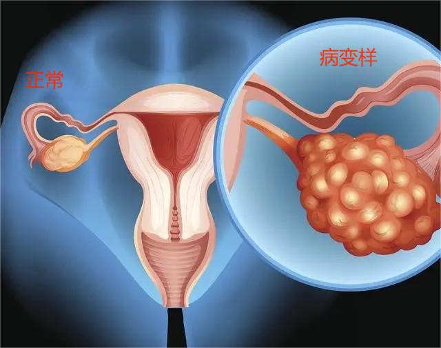 奥拉帕利联合贝伐珠单抗治疗晚期卵巢癌PFS 37.2个月