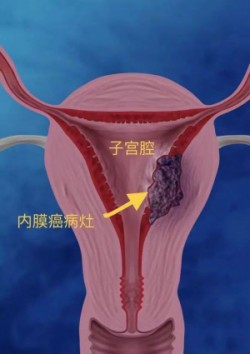 多塔利单抗治疗具有错配修复基因缺陷的实体瘤效果如何？