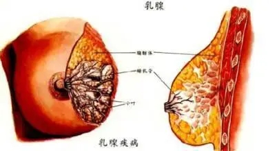 帕博西尼+氟维司群治疗晚期乳腺癌能活多久？生存期提高6.9月