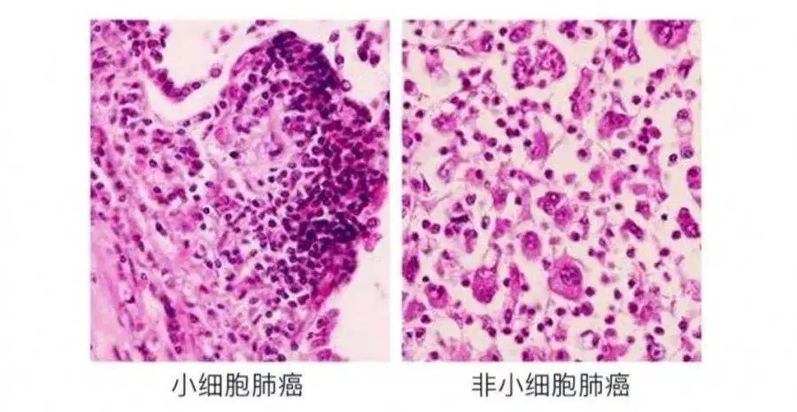 卢比替定治疗小细胞肺癌客观缓解率35.2%，已在美国上市